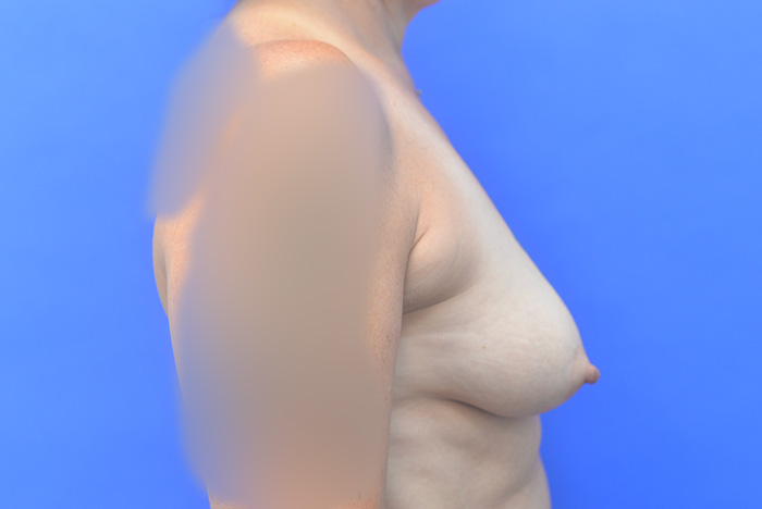 Breast Augmentation Mastopexy Before and After | Simply Breasts