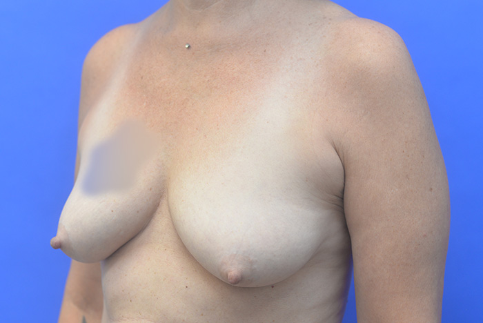 Breast Augmentation Mastopexy Before and After | Simply Breasts