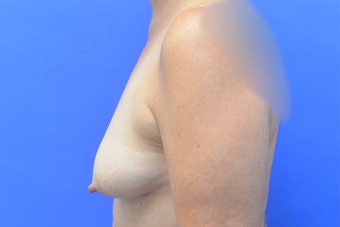 Breast Augmentation Mastopexy Before and After | Simply Breasts