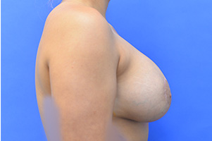 Breast Augmentation Before and After | Simply Breasts