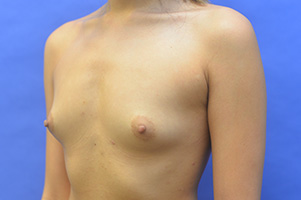 Breast Augmentation Before and After | Simply Breasts