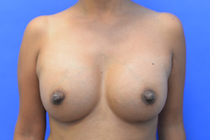 Breast Augmentation Before and After | Simply Breasts