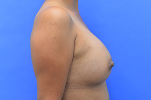 Breast Augmentation Before and After | Simply Breasts