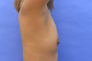 Breast Augmentation Before and After | Simply Breasts