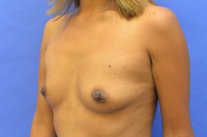 Breast Augmentation Before and After | Simply Breasts