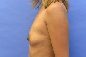 Breast Augmentation Before and After | Simply Breasts