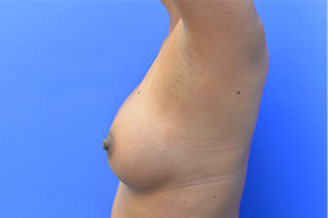 Breast Augmentation Before and After | Simply Breasts