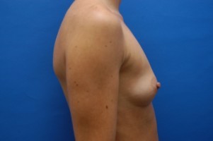 Breast Augmentation Before and After | Simply Breasts
