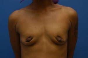 Breast Augmentation Before and After | Simply Breasts
