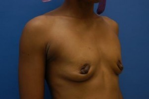 Breast Augmentation Before and After | Simply Breasts