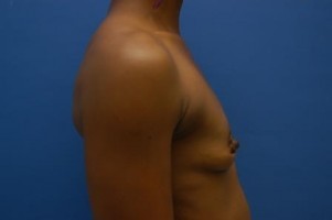 Breast Augmentation Before and After | Simply Breasts