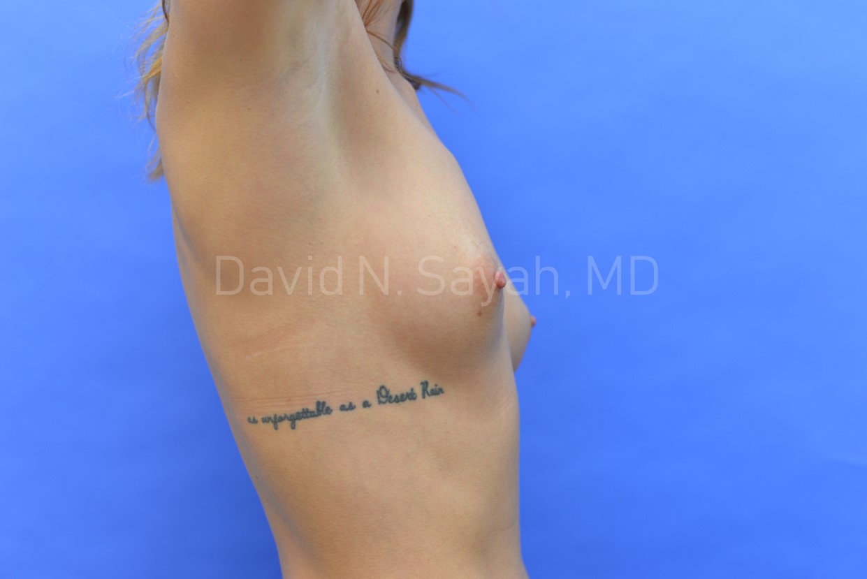 Breast Augmentation Before and After | Simply Breasts