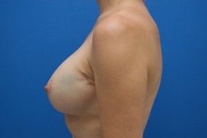 Breast Implant Exchange Before and After | Simply Breasts