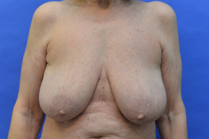 Breast Lift Before and After | Simply Breasts