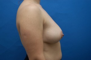 Breast Lift Before and After | Simply Breasts