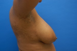 Breast Lift Before and After | Simply Breasts