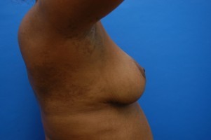 Breast Lift Before and After | Simply Breasts