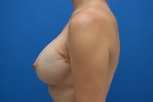 Breast Reconstruction Before and After | Simply Breasts