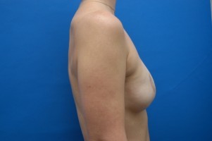 Breast Reconstruction Before and After | Simply Breasts