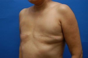 Breast Reconstruction Before and After | Simply Breasts