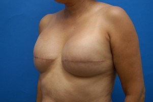 Breast Reconstruction Before and After | Simply Breasts