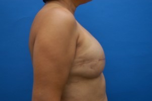 Breast Reconstruction Before and After | Simply Breasts