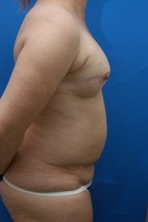 Breast Reconstruction Before and After | Simply Breasts