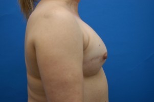 Breast Reconstruction Before and After | Simply Breasts