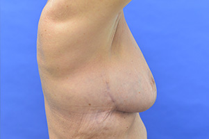 Breast Reduction Before and After | Simply Breasts