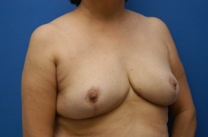 Breast Reduction Before and After | Simply Breasts