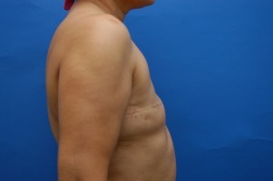 Fat Injection Before and After | Simply Breasts