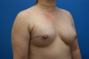Fat Injection Before and After | Simply Breasts