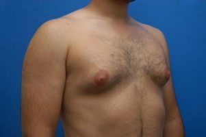 Male Breast Reduction Before and After | Simply Breasts