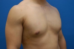 Male Breast Reduction Before and After | Simply Breasts