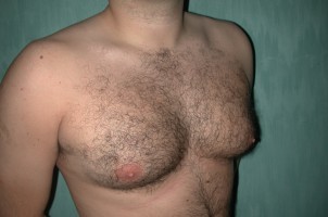 Male Breast Reduction Before and After | Simply Breasts