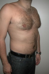 Male Breast Reduction Before and After | Simply Breasts