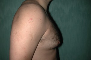 Male Breast Reduction Before and After | Simply Breasts