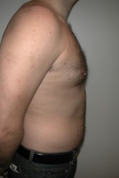 Male Breast Reduction Before and After | Simply Breasts