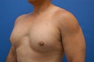 Nipple Revision Before and After | Simply Breasts