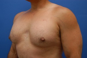Nipple Revision Before and After | Simply Breasts