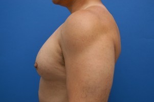 Nipple Revision Before and After | Simply Breasts